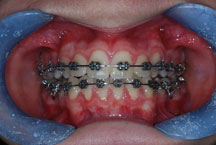 fixed orthodontic