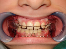 removable orthodontic