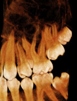 3-d volume of teeth